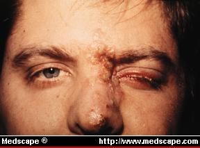 HERPES Y VACUNAS COVID